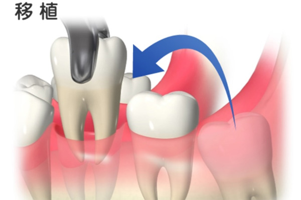歯の移植・再植とは？自家歯牙移植とは？