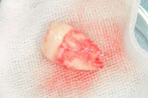 歯の移植（自家歯牙移植）のメカニズム