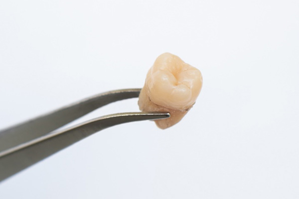 移植（自家歯牙移植）のタイミング・方法は？