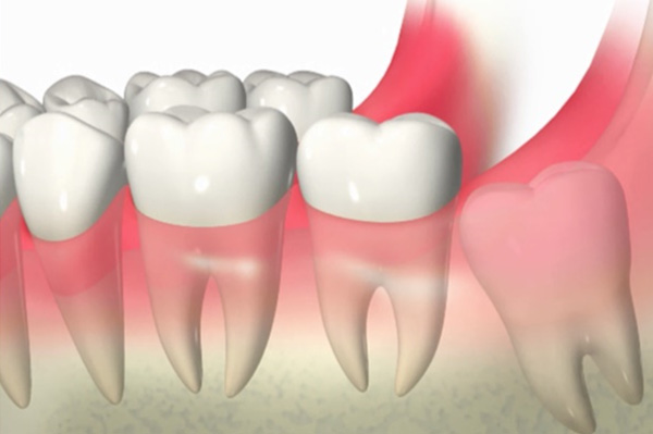 歯の移植（自家歯牙移植）のデメリット