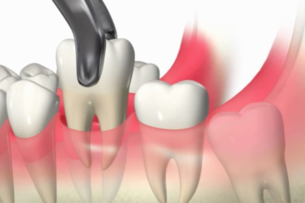歯の移植（自家歯牙移植）のメリット